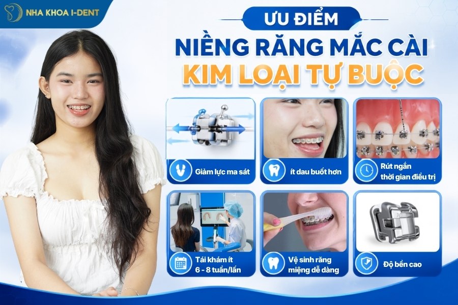 niềng răng mắc cài kim loại tự buộc