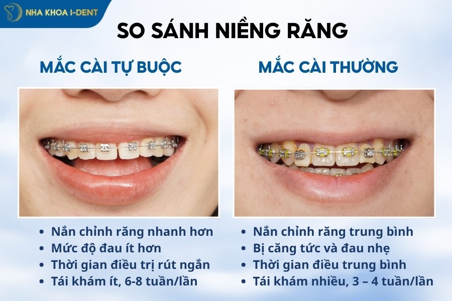 niềng răng mắc cài kim loại tự buộc