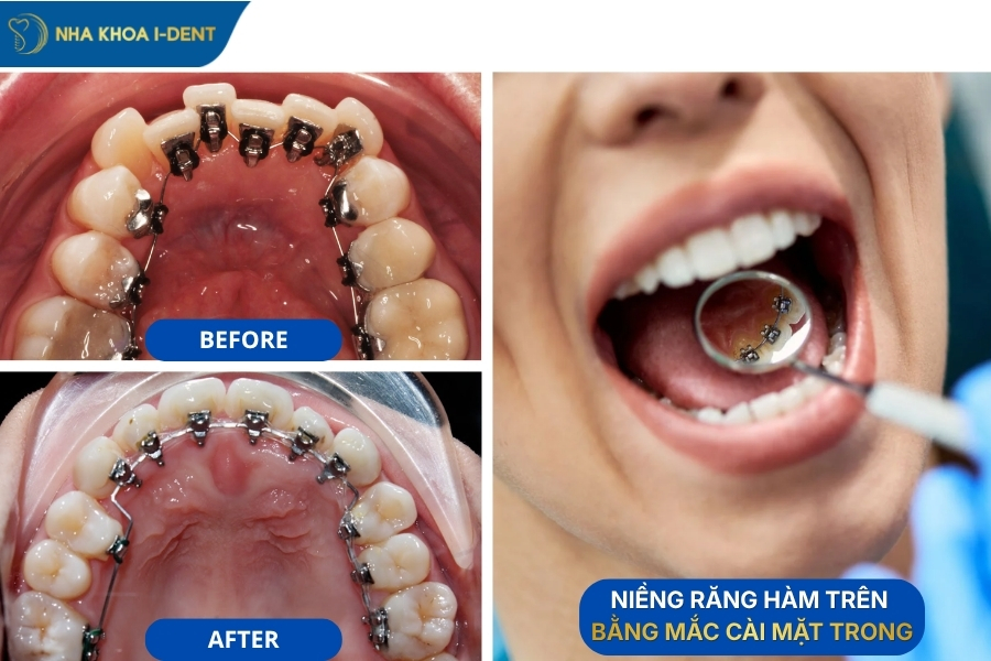 niềng răng một hàm trên có được hay không