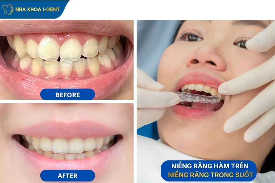 niềng răng một hàm trên
