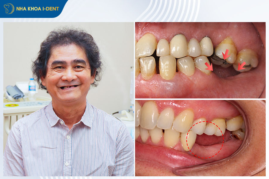 Răng bị mất chân răng có trồng được không