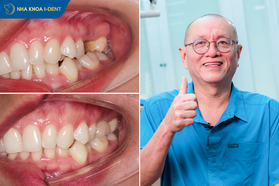 răng số 7 nhổ có cần trồng lại