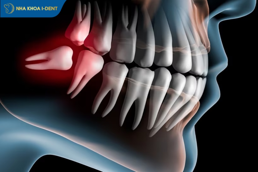 Răng số 8 nhổ có ảnh hưởng gì không