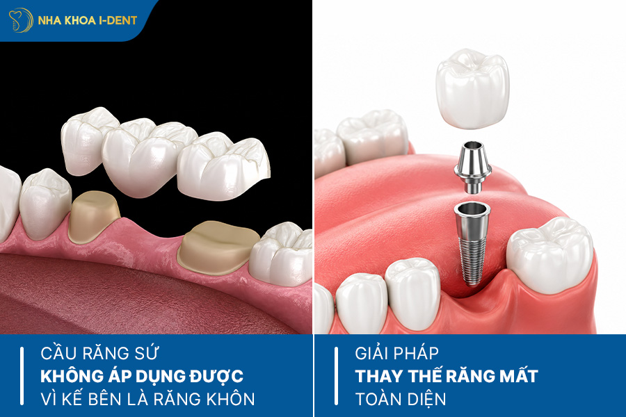 sau khi nhổ răng số 7 có cần trồng lại không