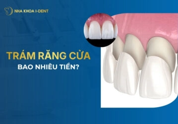 trám răng cửa bao nhiêu tiền