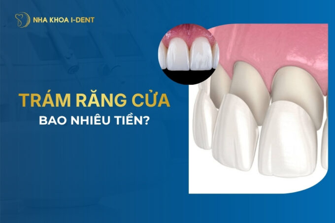 trám răng cửa bao nhiêu tiền