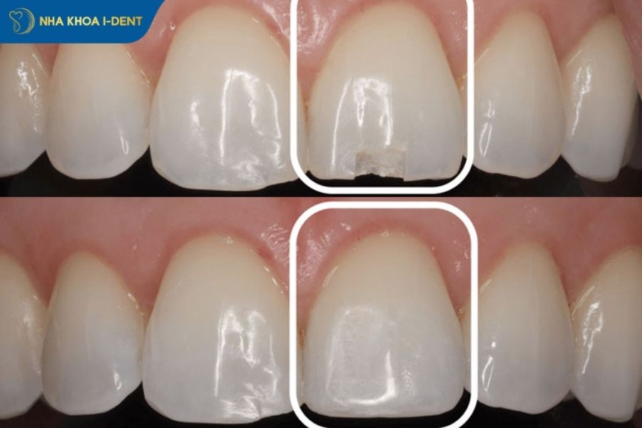 trám răng cửa bị mẻ giá bao nhiêu