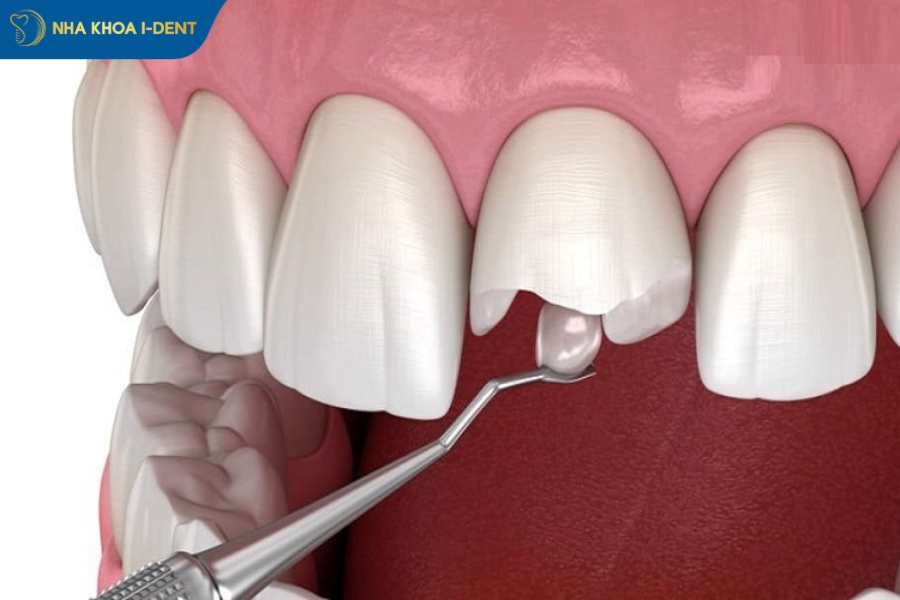 trám răng cửa bị sâu giá bao nhiêu