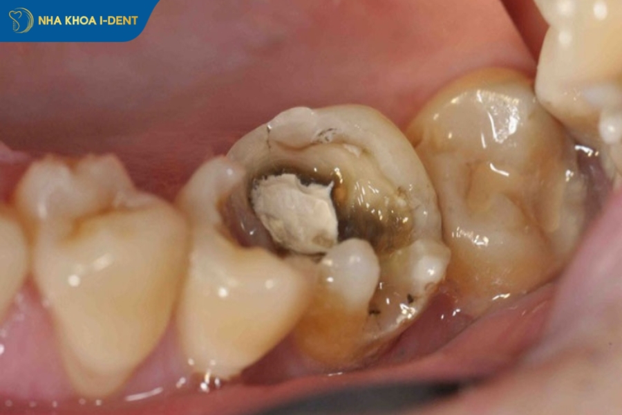 trám răng và lấy tủy giá bao nhiêu