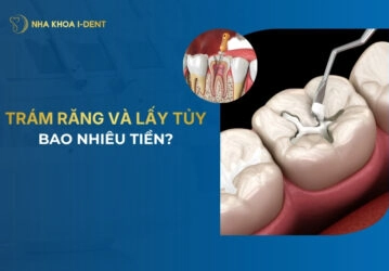 trám răng và lấy tủy giá bao nhiêu
