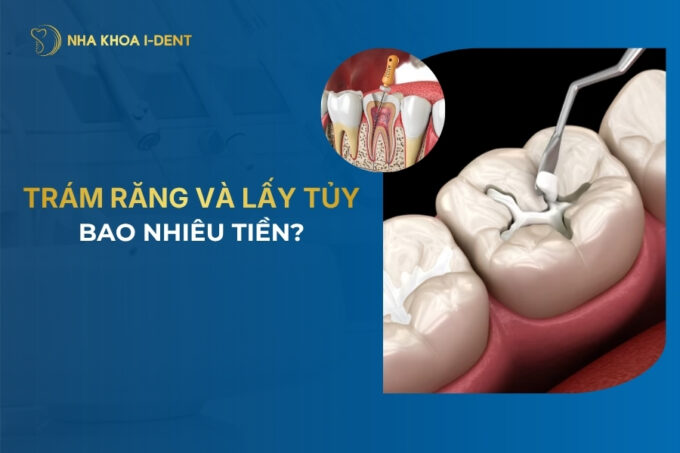 trám răng và lấy tủy giá bao nhiêu