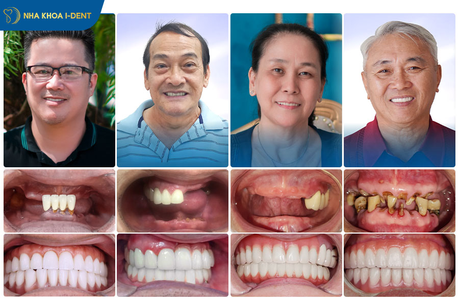 trồng răng implant Thụy Sĩ