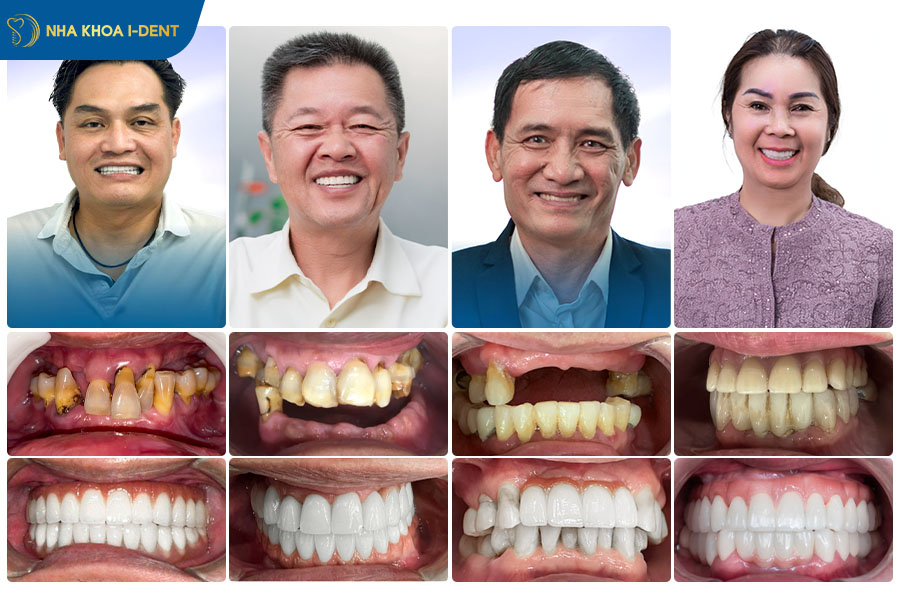 trụ implant thụy sĩ giá bao nhiêu