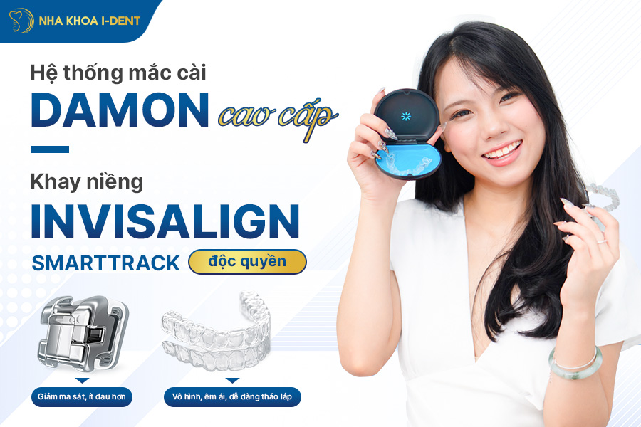 các gói niềng răng và giá
