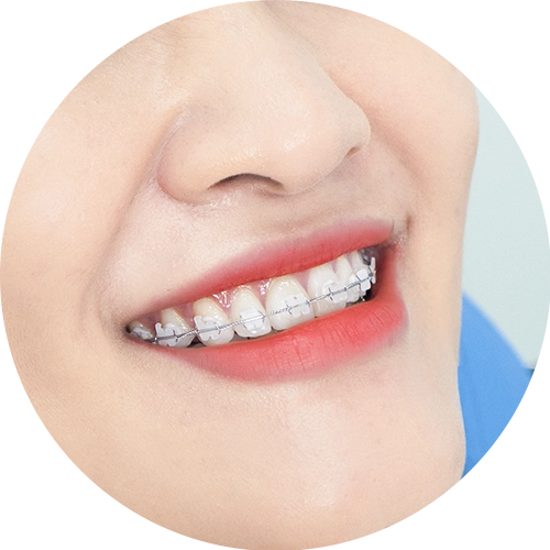 Niềng răng mắc cài sứ