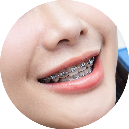 Niềng răng mắc cài kim loại
