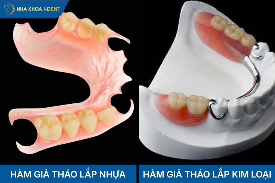 các loại trồng răng tháo lắp