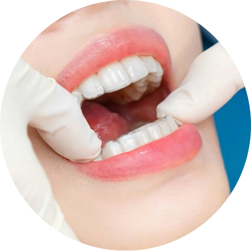 Niềng răng trong suốt Invisalign