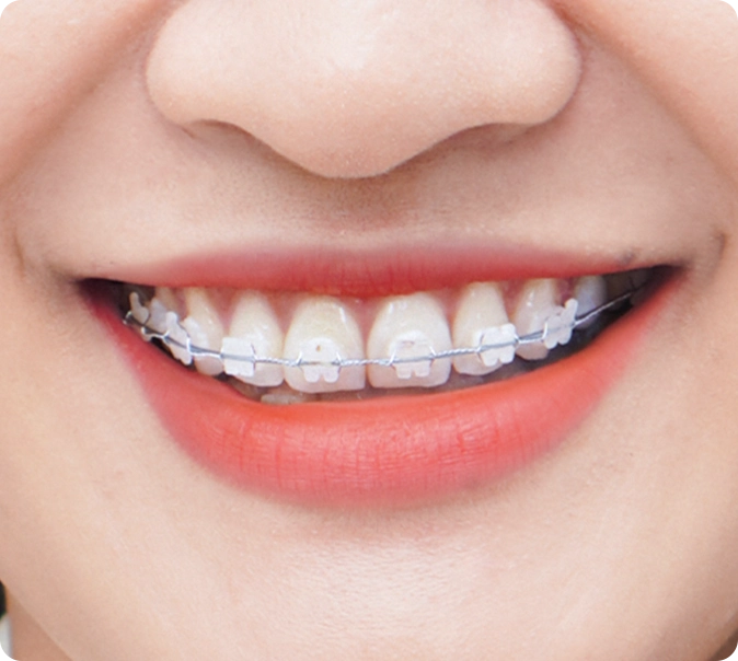 Niềng răng mắc cài sứ tiêu chuẩn