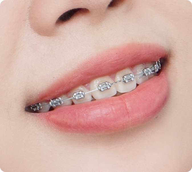 Niềng răng mắc cài thường