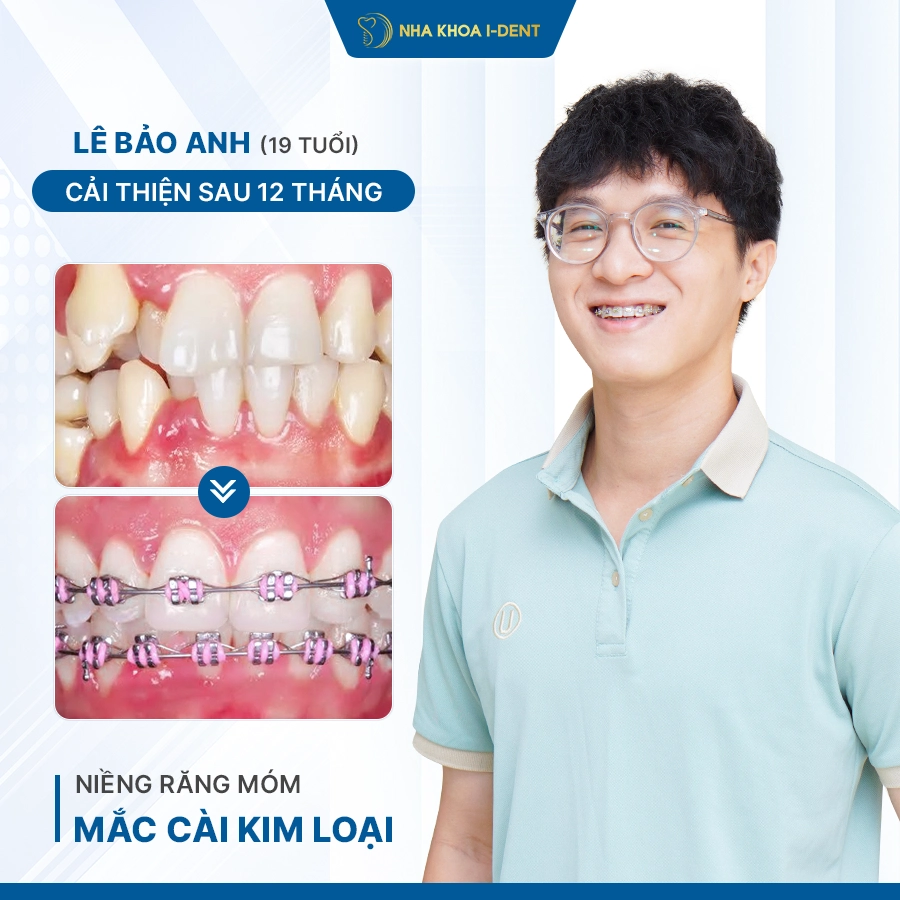 niềng răng bao nhiêu tiền 1 hàm - Nha khoa I-Dent
