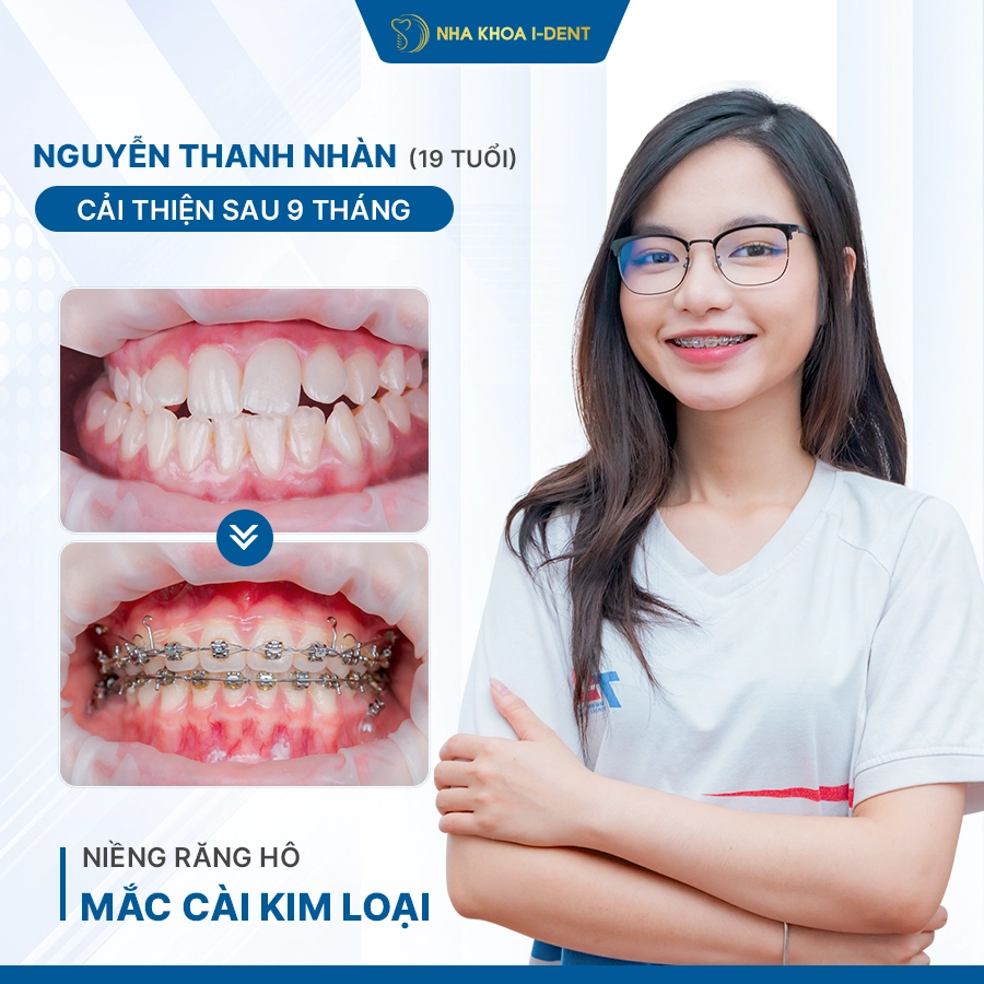giá niềng răng trong suốt 1 hàm - Nha khoa I-Dent