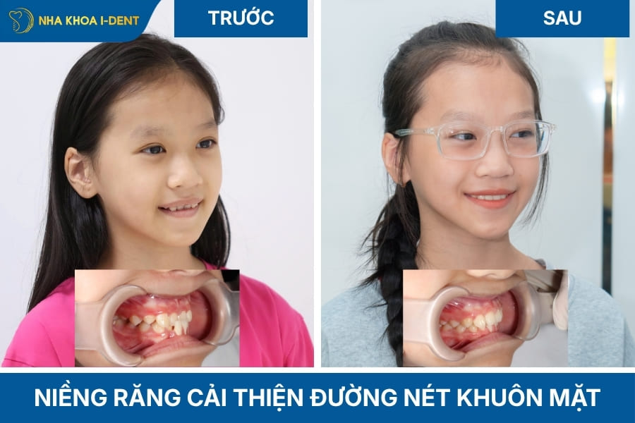 niềng răng có giúp mặt cân đối hơn không