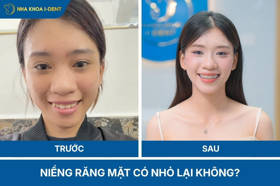 niềng răng có giúp mặt thon gọn