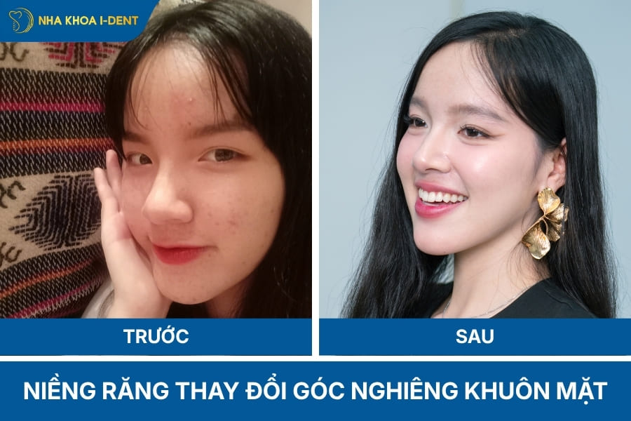 niềng răng có giúp thu gọn hàm không