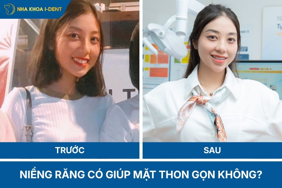 niềng răng có làm hàm nhỏ lại không
