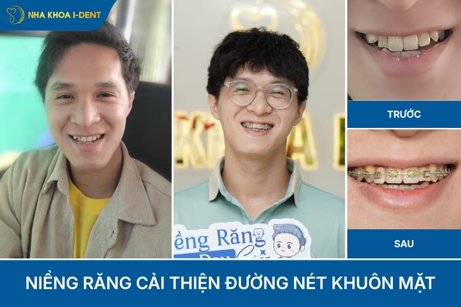 niềng răng có làm mặt nhỏ lại