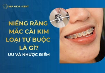 Niềng răng mắc cài kim loại tự buộc là gì? Ưu và nhược điểm