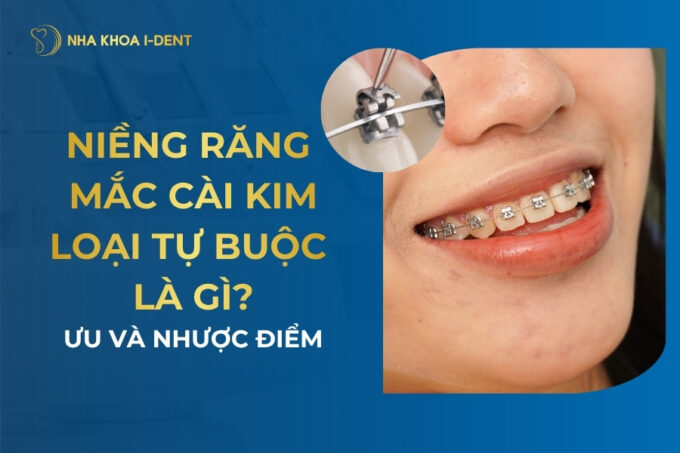 Niềng răng mắc cài kim loại tự buộc là gì? Ưu và nhược điểm