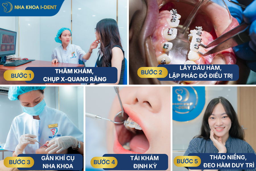 niềng răng giả