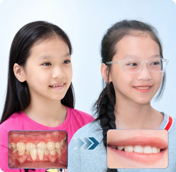 Invisalign hiệu quả tròn điều trị hầu hết hô, móm, thưa