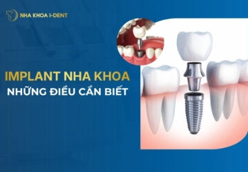 implant nha khoa