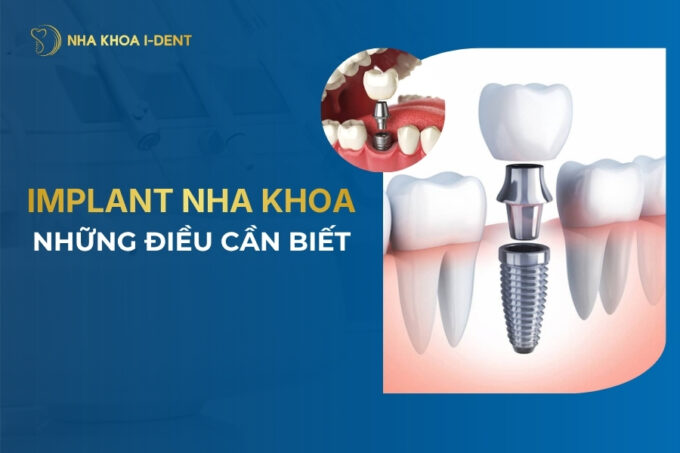 implant nha khoa