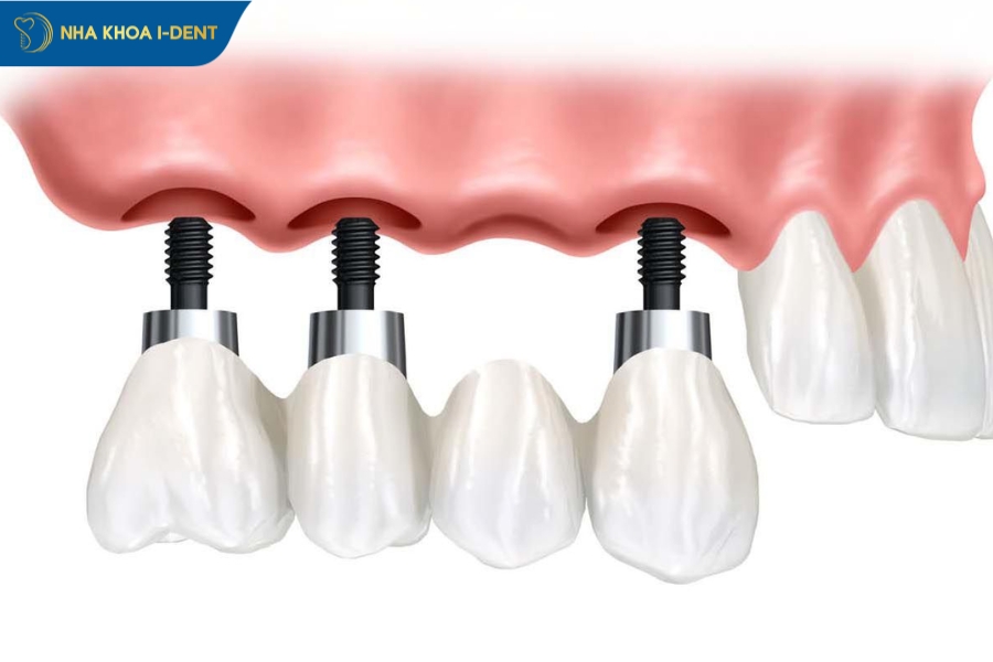 implant nha khoa cầu răng
