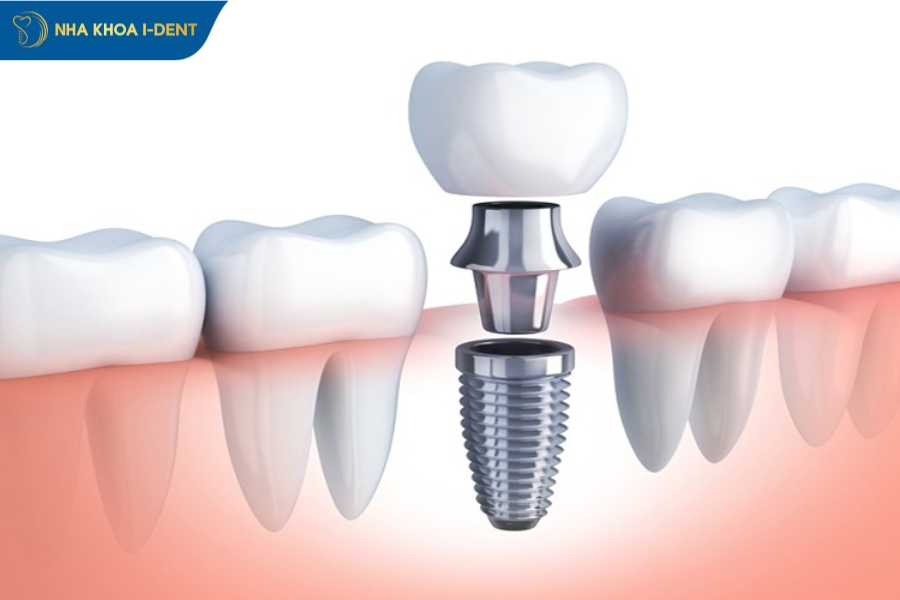 implant nha khoa đơn lẻ