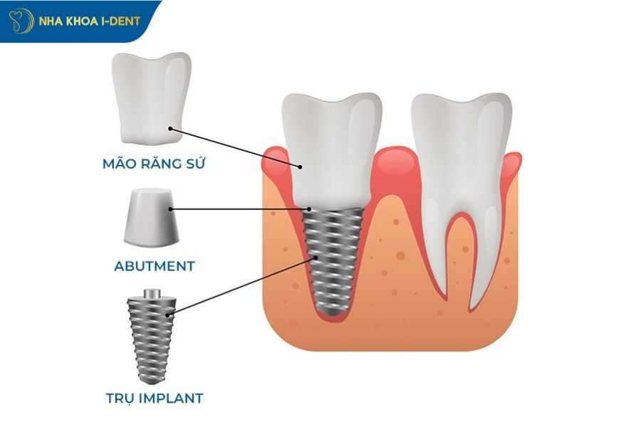 implant nha khoa là gì