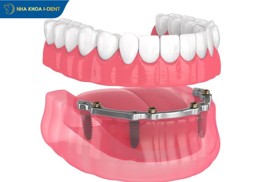implant nha khoa toàn hàm
