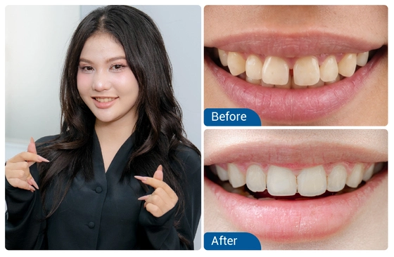 Nguyễn Thị Thu Hường niềng răng mắc cài