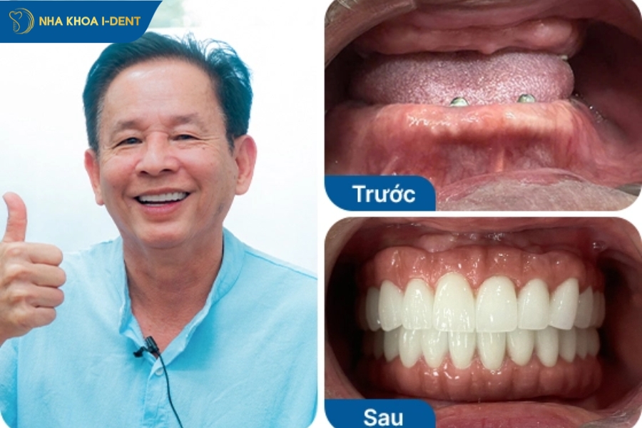 trụ implant nha khoa