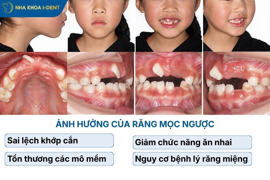 răng mọc ngược