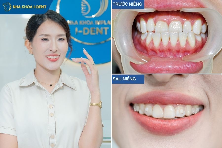 Hình ảnh niềng răng trong suốt cho răng móm