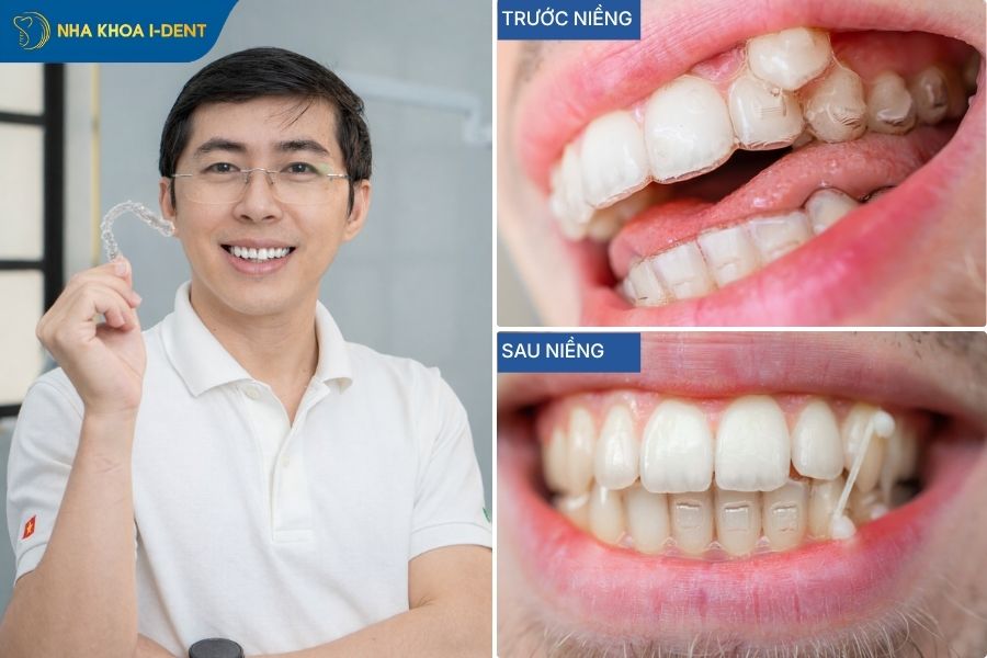 Hình ảnh niềng răng trong suốt cho khấp khểnh