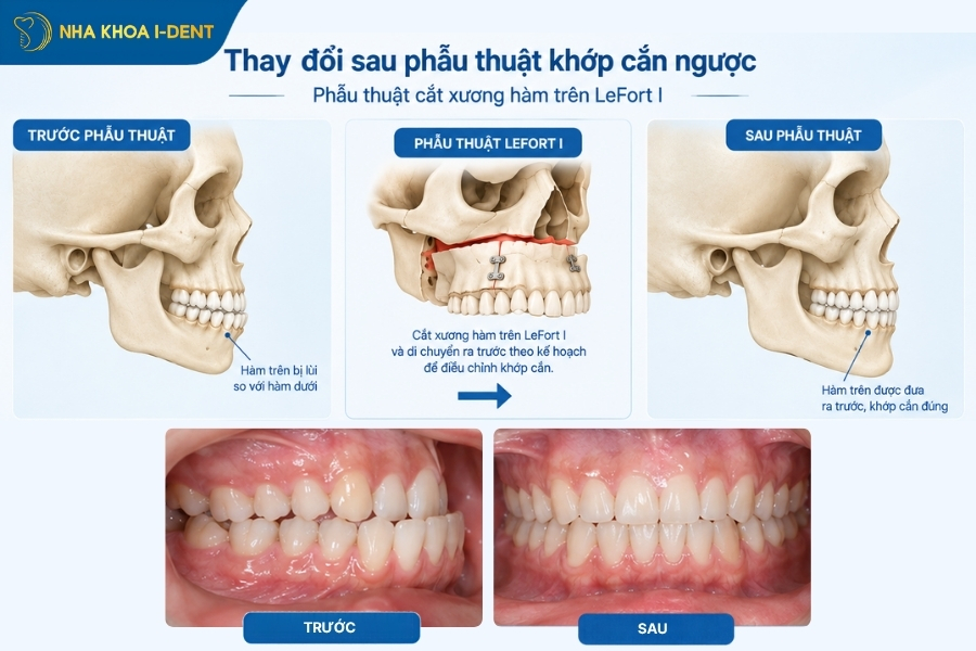 bị khớp cắn ngược phải làm sao