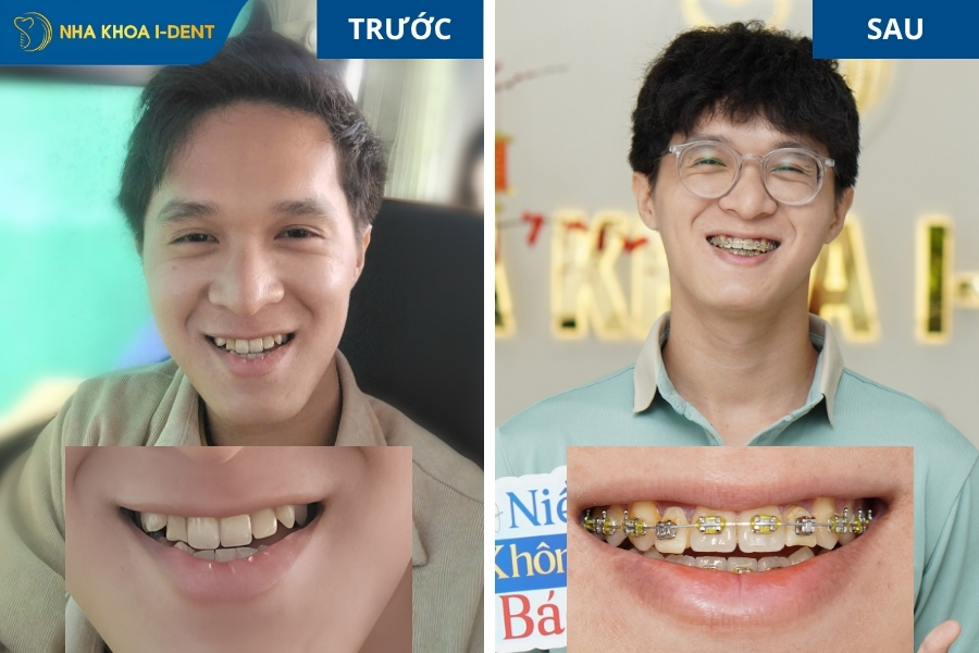 cách chữa khớp cắn ngược