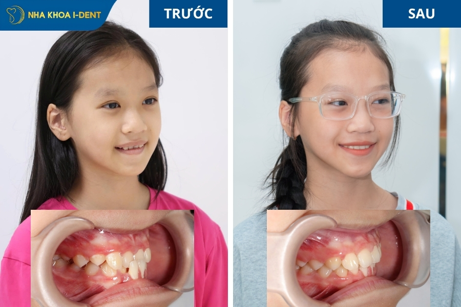 cách khắc phục khớp cắn ngược