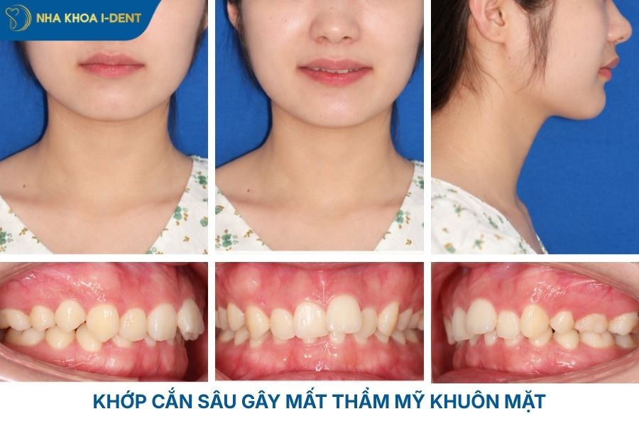 khớp cắn sâu là gì